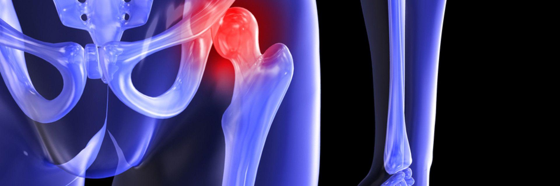 A csípőízület második fokozatának deformáló artrózisa Fogyás és ízületi fájdalmak